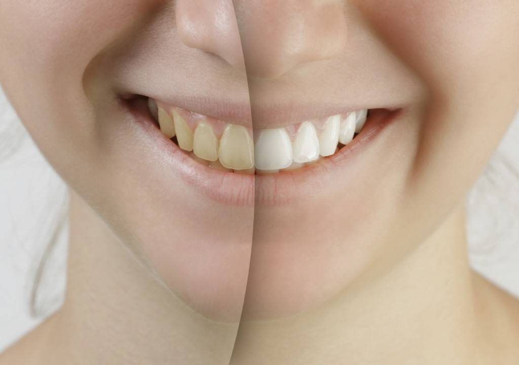 علت زرد شدن رنگ دندان ها چیست و چه راه هایی برای از بین بردن زردی دندان وجود دارد؟