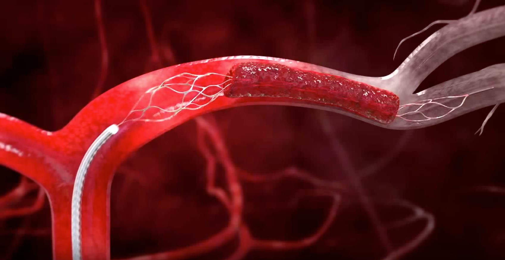 ارتباط رگ های واریسی با افزایش احتمال لختگی خون