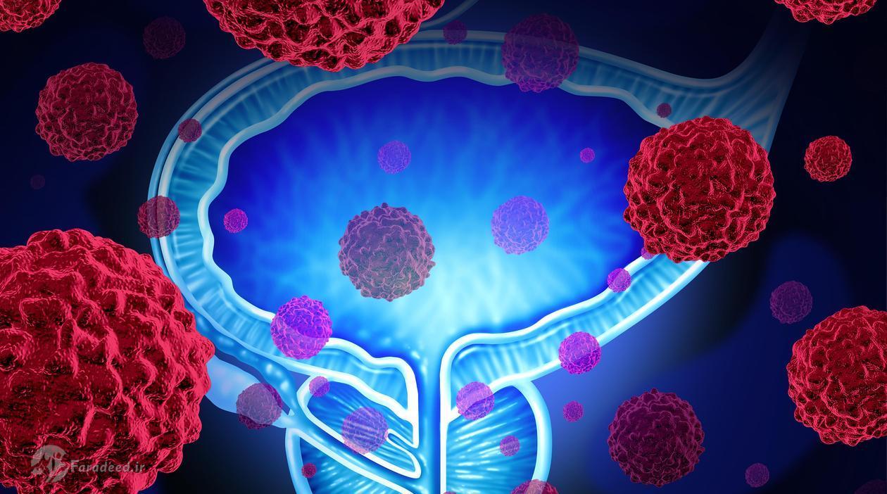 بیماری التهابی روده خطر سرطان پروستات را افزایش می دهد