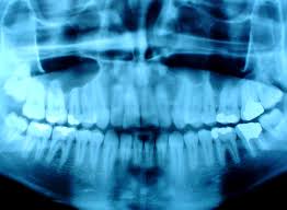 تشخیص دقیق پوسیدگی دندان با استفاده از علم رادیولوژی