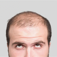 آیا روش های درمان مو موثر هستند