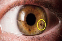 تشخیص عارضه چشمی دژنراسیون ماکولا