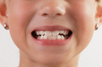 آمار بالای خرابی دندان های شیری کودکان ایرانی