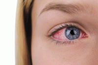 علل سوزش چشم ها و درمان آن