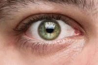 لکه های زرد چشم نشانه اولیه ابتلا به زوال عقل