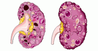 بیش از 50درصد افراد بالای پنجاه سال به کیست کلیه مبتلا می شوند