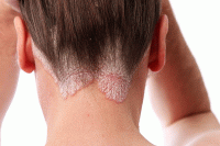 روش های خانگیِ درمان قارچ پوستی